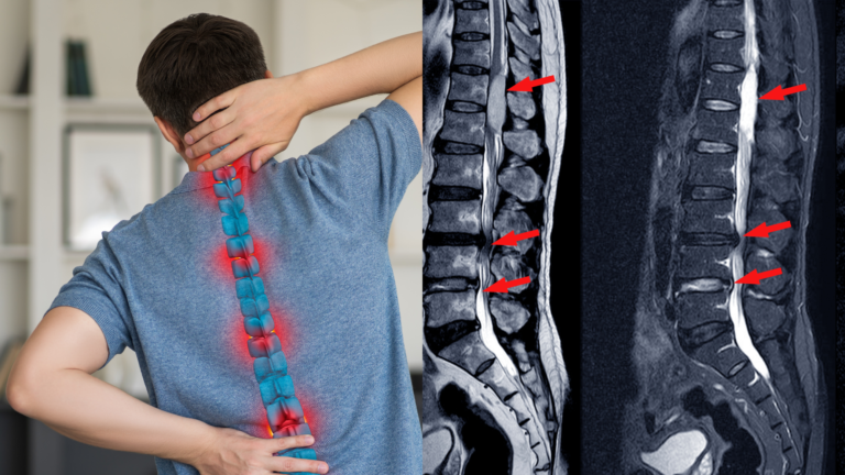 स्पाइनल स्टेनोसिस ICD 10
